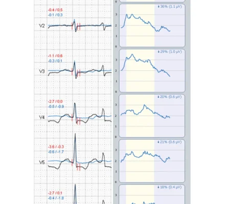 HyperQ Stress HyperQ Stress